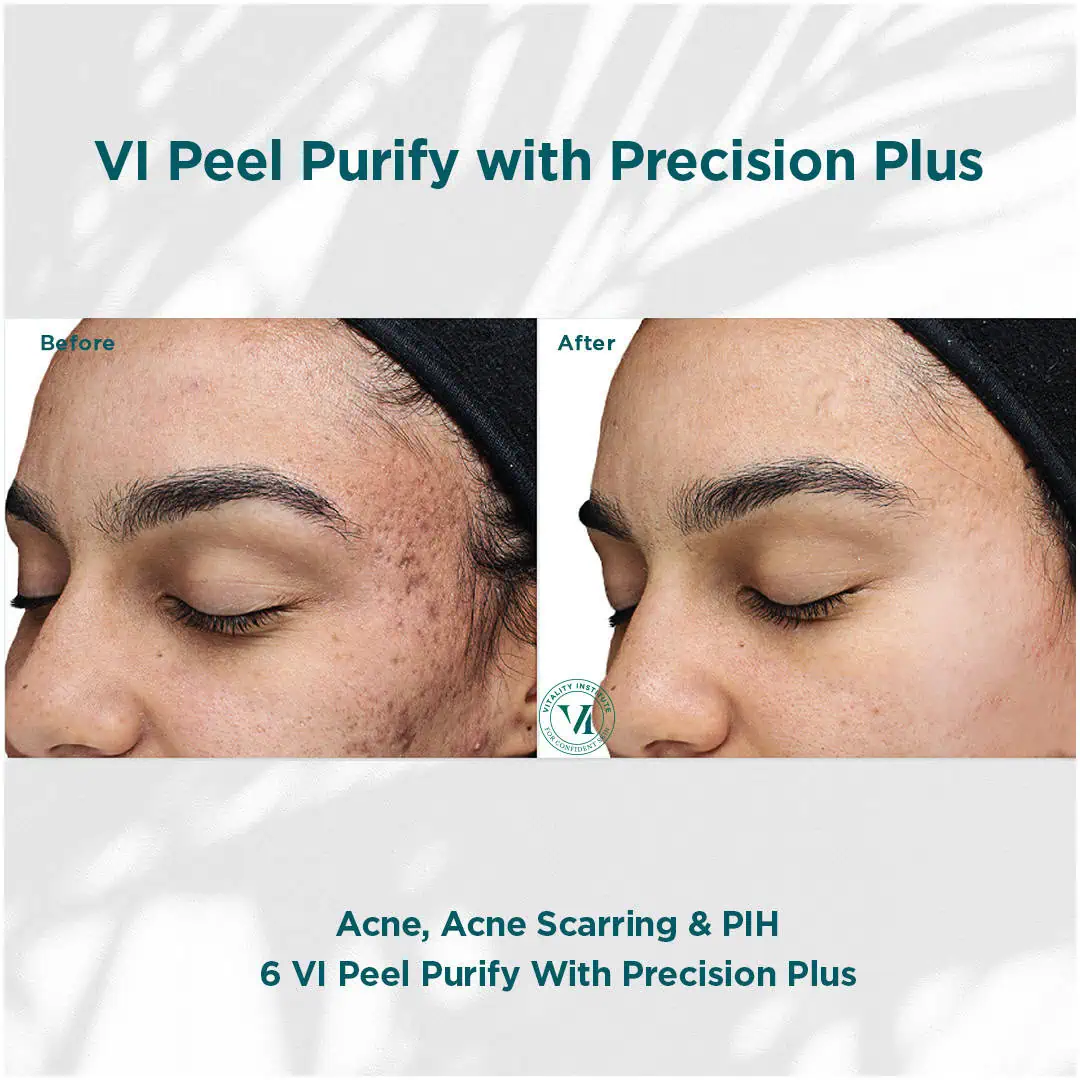 Acne-Acne Scarring