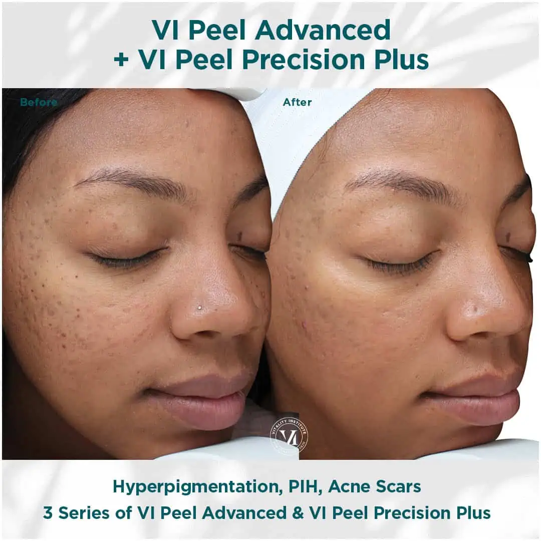 Hyperpigmentation-PIH-Acne Scars